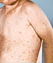 Measles Concern!